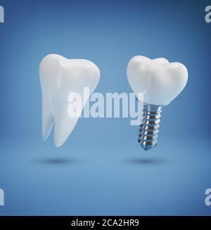 Vector with realistic dental implant and healthy tooth on a blue background. 3d. Element for design, layout template for dental clinics Stock Photo