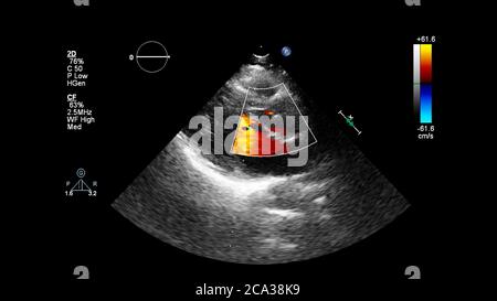 Image of the heart during transesophageal ultrasound with Doppler mode. Stock Photo