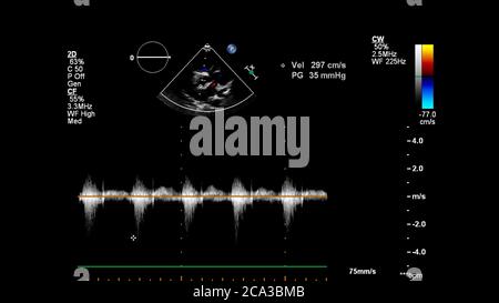 Image of the heart during transesophageal ultrasound with Doppler mode. Stock Photo