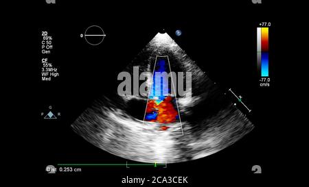 Image of the heart during transesophageal ultrasound with Doppler mode. Stock Photo