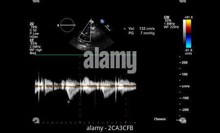 Image of the heart during transesophageal ultrasound with Doppler mode. Stock Photo