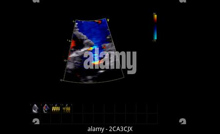 Image of the heart during transesophageal ultrasound with Doppler mode. Stock Photo