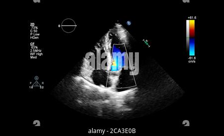 Image of the heart during transesophageal ultrasound with Doppler mode. Stock Photo