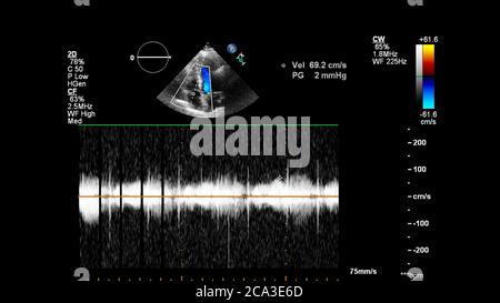 Image of the heart during transesophageal ultrasound with Doppler mode. Stock Photo