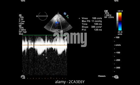 Image of the heart during transesophageal ultrasound with Doppler mode. Stock Photo