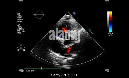 Image of the heart during transesophageal ultrasound with Doppler mode. Stock Photo