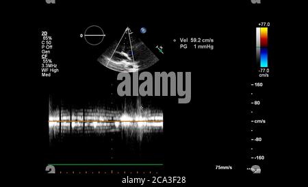 Image of the heart during transesophageal ultrasound with Doppler mode. Stock Photo