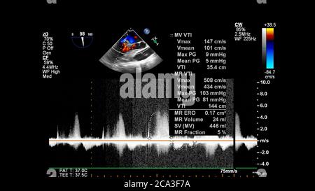 Image of the heart during transesophageal ultrasound with Doppler mode. Stock Photo