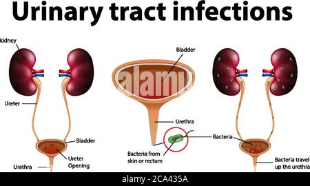 Informative illustration of urinary tract infections illustration Stock Vector