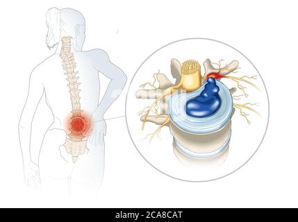 illustration showing lumbal vertebra with intervertebral disc and herniated nucleus pulposus Stock Photo