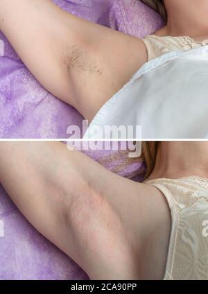 Depilation zone underarms. Close up photo before and after.  Stock Photo