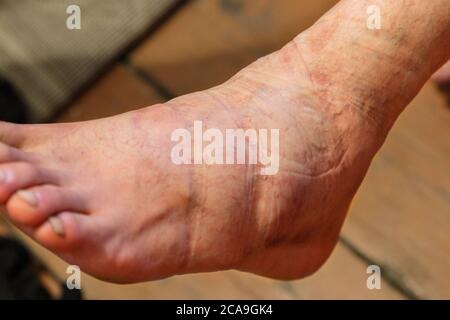 A close-up of a man's injured foot swollen from a sprained fracture. Stock Photo