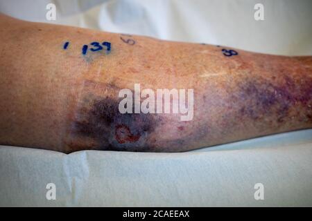 a large haematoma is located on a lower leg, its spread is marked with a pen Stock Photo