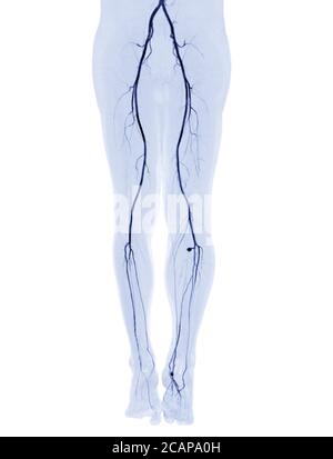 CTA femoral artery run off image of femoral artery for diagnosis Acute ...