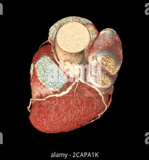 Top view of CTA Coronary artery  3D rendering image isolated o black backgroud for finding coronary artery disease.Clippig path. Stock Photo
