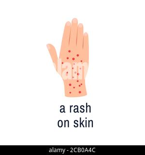 Skin rash icon isolated on white Allergy hand palm Stock Vector