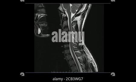 Magnetic Resonance images of Cervical spine sagittal T2-weighted images (MRI Cervical spine) showing mild disc disease. Stock Photo