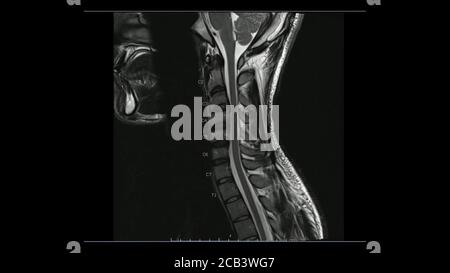 Magnetic Resonance images of Cervical spine sagittal T1-weighted image ...