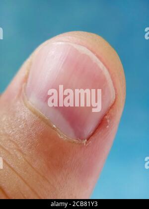 Man finger close up, dry cuticle, chapped skin. a finger of a man with the skin exfoliated around the nail Stock Photo