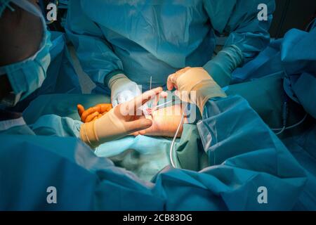 two doctors operate on a wrist fracture in an operating theatre Stock Photo