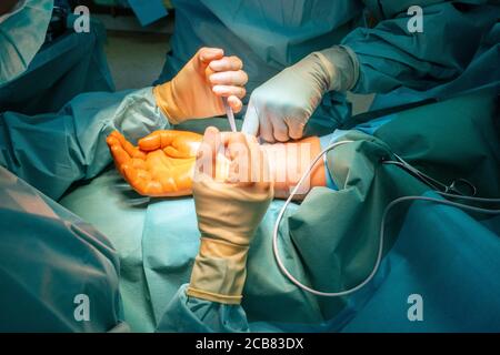 two doctors operate on a wrist fracture in an operating theatre Stock Photo