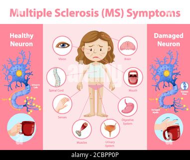 Multiple sclerosis (MS) symptoms information infographic illustration Stock Vector