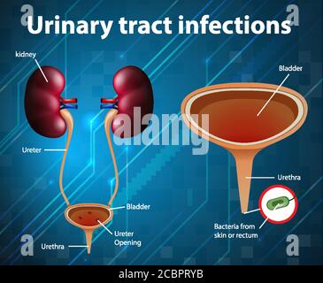 Informative illustration of urinary tract infections illustration Stock Vector