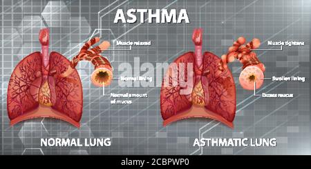 Asthma diagram with normal lung and asthmatic lung illustration Stock ...