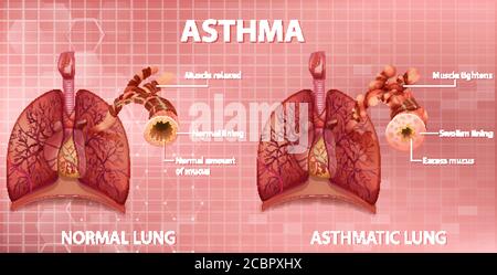 Asthma Pathology. An illustration of lungs with a normal airway (left ...