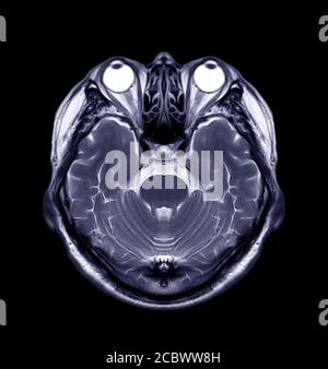 MRI brain scan sagittal flair for detect Brain diseases sush as stroke ...