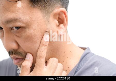 Acrochordon hi-res stock photography and images - Alamy