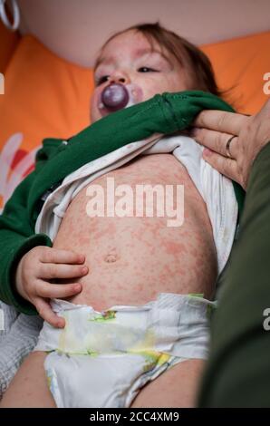 Children viral disease or allergies. Red measles rash on baby. Child with viral children disease infection. Concept of viral baby disease and vaccinat Stock Photo
