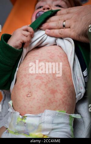 Children viral disease or allergies. Red measles rash on baby. Child with viral children disease infection. Concept of viral baby disease and vaccinat Stock Photo