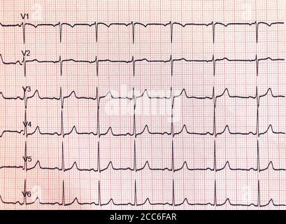 Electrocardiogram hospital examination. Sheet that represents a diagnostic test, of an instrumental type, which records and graphically reports Stock Photo