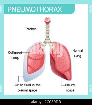 Pneumothorax cartoon of human anatomy illustration Stock Vector