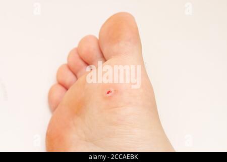 Plantar wart on foot. Open wound after wart removal on sole of foot. Papillomavirus Stock Photo