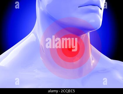 Sore Throat Concept - 3D Stock Photo