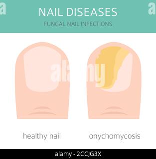 Nail diseases. Onychomycosis, nail fungal infection causes, treatment icon set. Medical infographic design.  Vector illustration Stock Vector