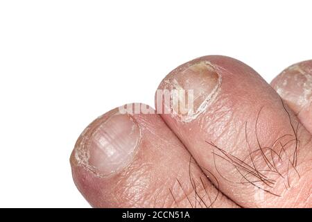 Macro photography of toe nails infected with Onychomycosis. Stock Photo