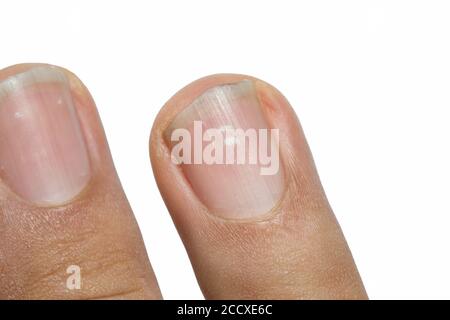 White marks on nails lucky or unlucky for you ssh | नाखून पर सफेद निशान शुभ  या अशुभ? एक बार करें चेक..जानें असल कारण! | Hindi News, ZeePHH Trending News