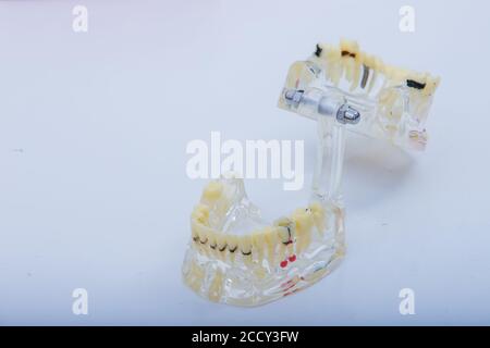 Dental prosthesis, dentures. dentist hands while working on the denture on white table Stock Photo