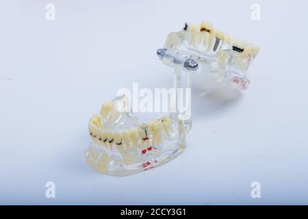 Dental prosthesis, dentures. dentist hands while working on the denture on white table Stock Photo