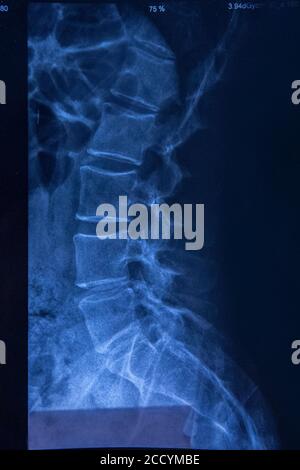 primary survey x ray cervical spine