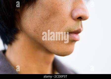 Closeup to Blemish on cheek of the man skin Stock Photo