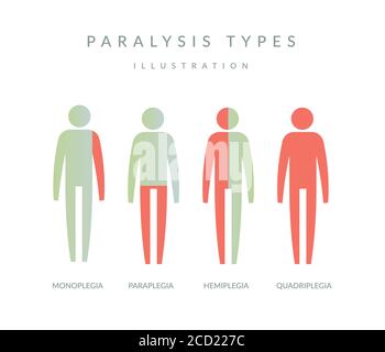 Types of Paralysis - Illustration as EPS 10 File Stock Vector