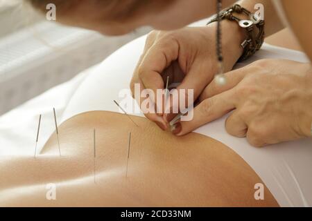 Alternative medicine. Master is injecting steel needles during procedure of acupuncture therapy.