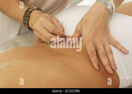 Alternative medicine. Master is injecting steel needles during procedure of acupuncture therapy.
