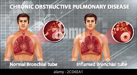 Chronic obstructive pulmonary disease illustration Stock Vector