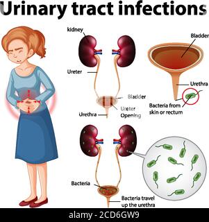 Informative illustration of urinary tract infections illustration Stock Vector