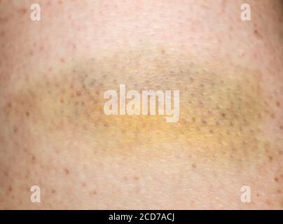 Large bruise hematoma on the humans leg on the skin in different colors Stock Photo